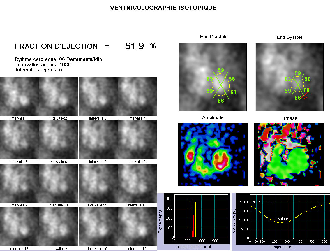 Fraction d’éjection LeCiber.fr