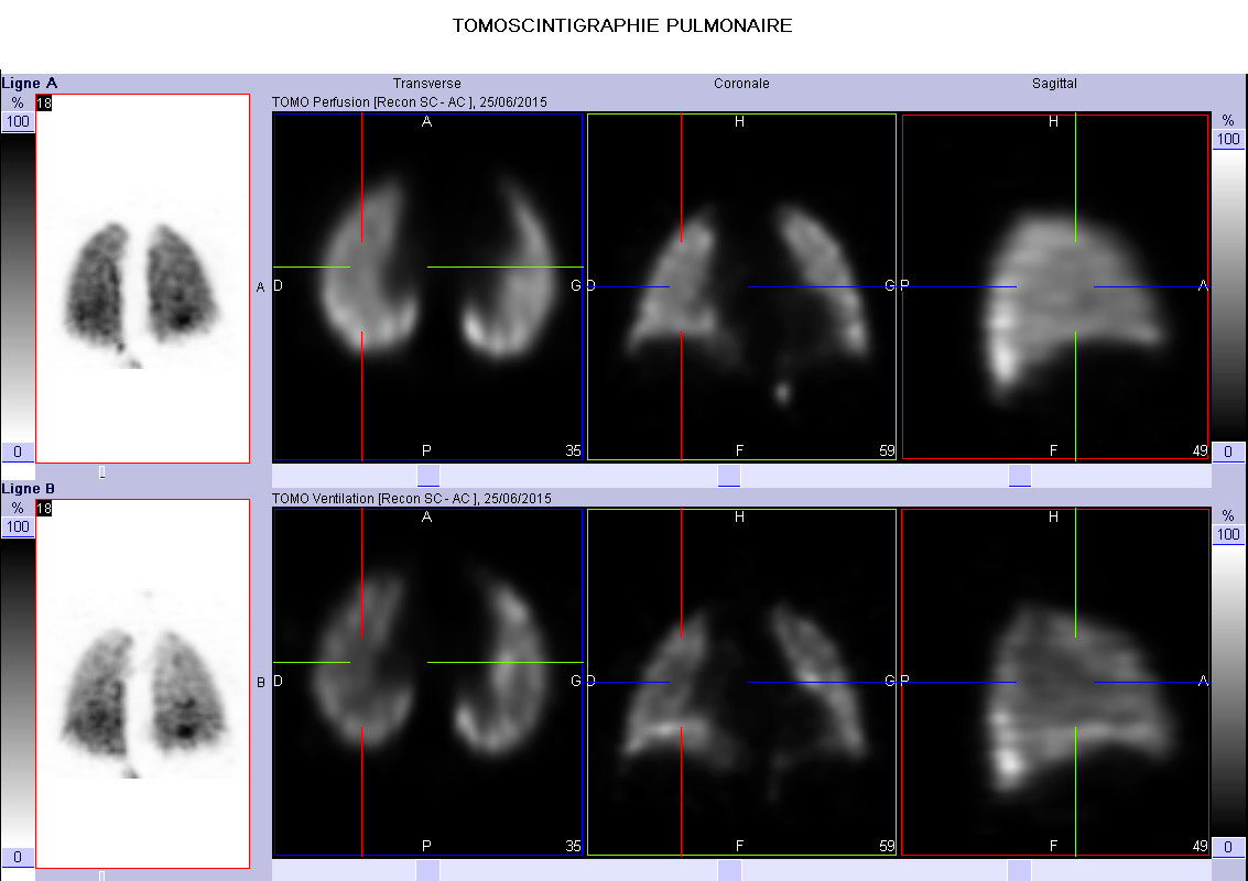 LeCiber.fr | Scintigraphie pulmonaire