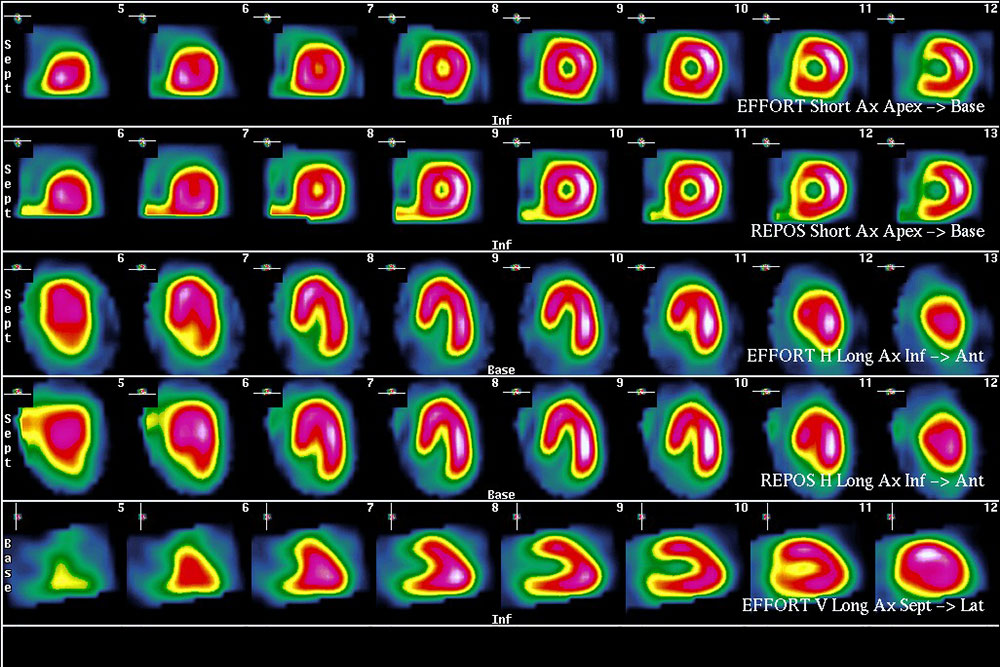 Scintigraphie Myocardique LeCiber fr